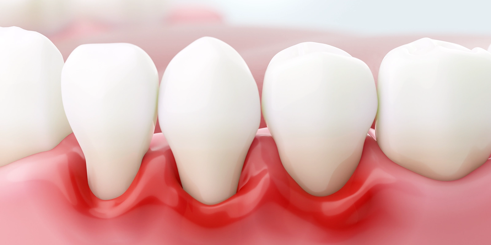 歯周外科治療とは