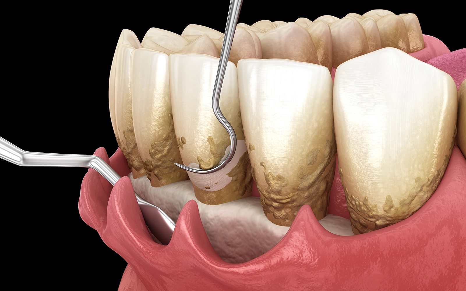 フラップ手術による徹底的な歯根面の清掃