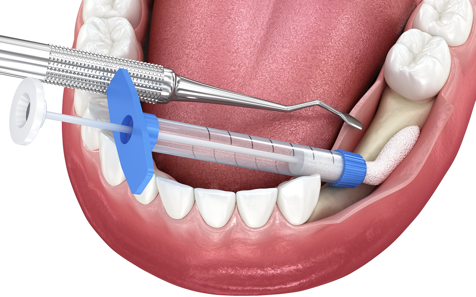 歯周組織再生療法による骨の回復