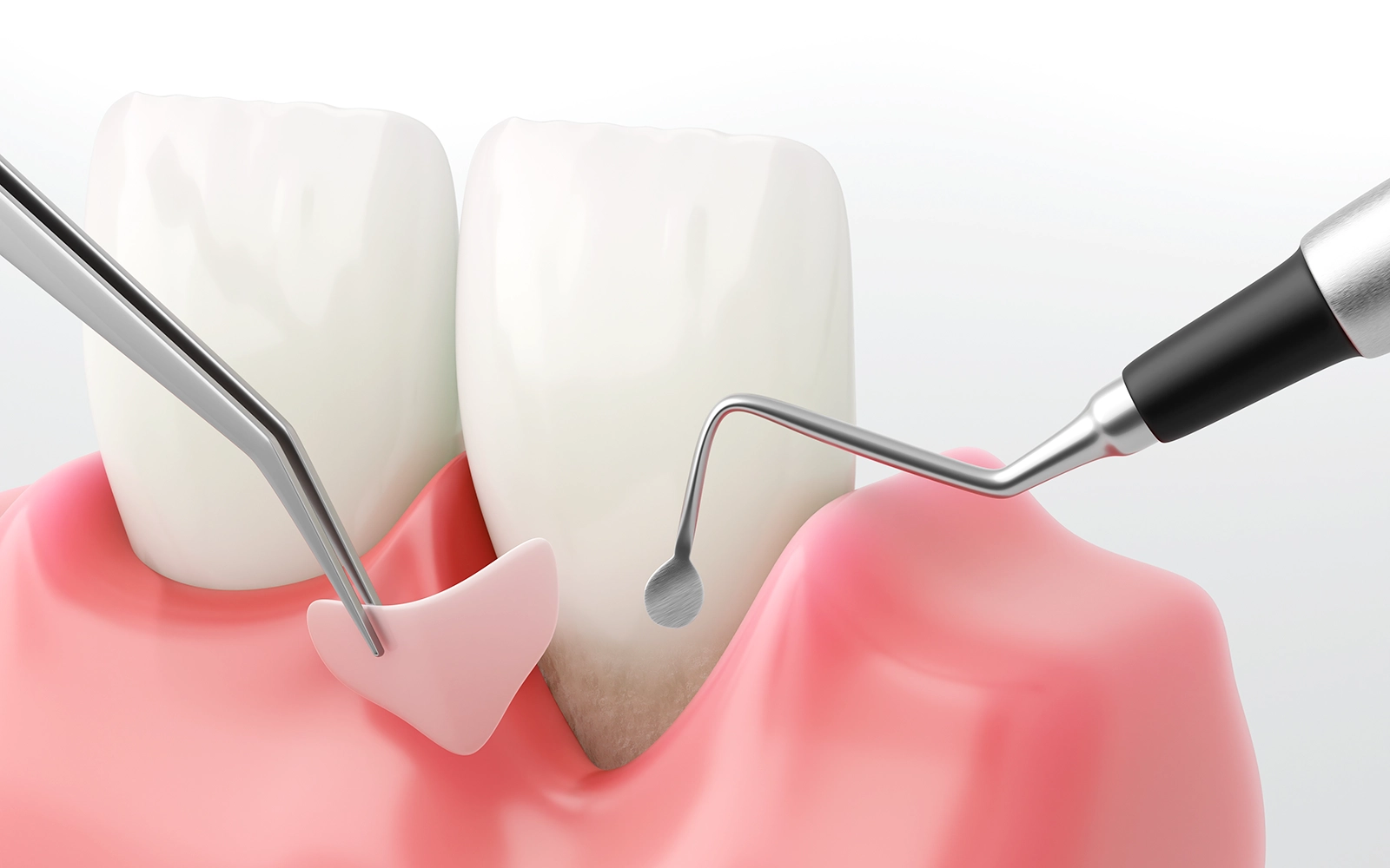 歯肉移植術や歯肉弁根尖側移動術