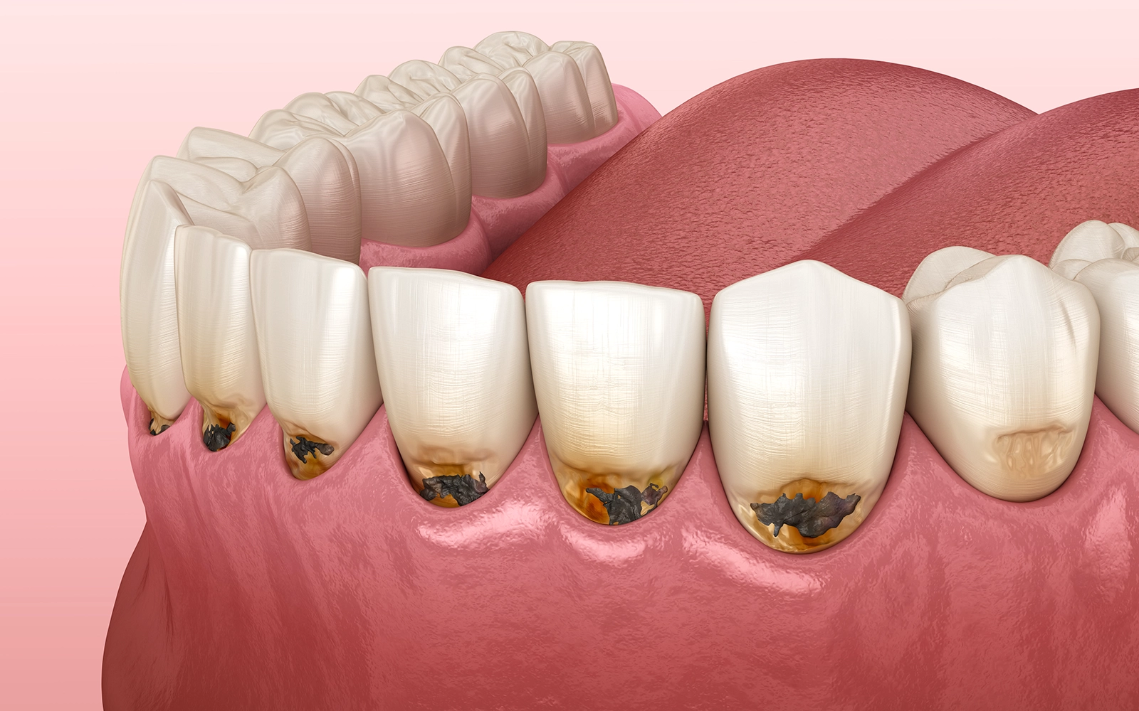 虫歯治療における補綴の決定的重要性