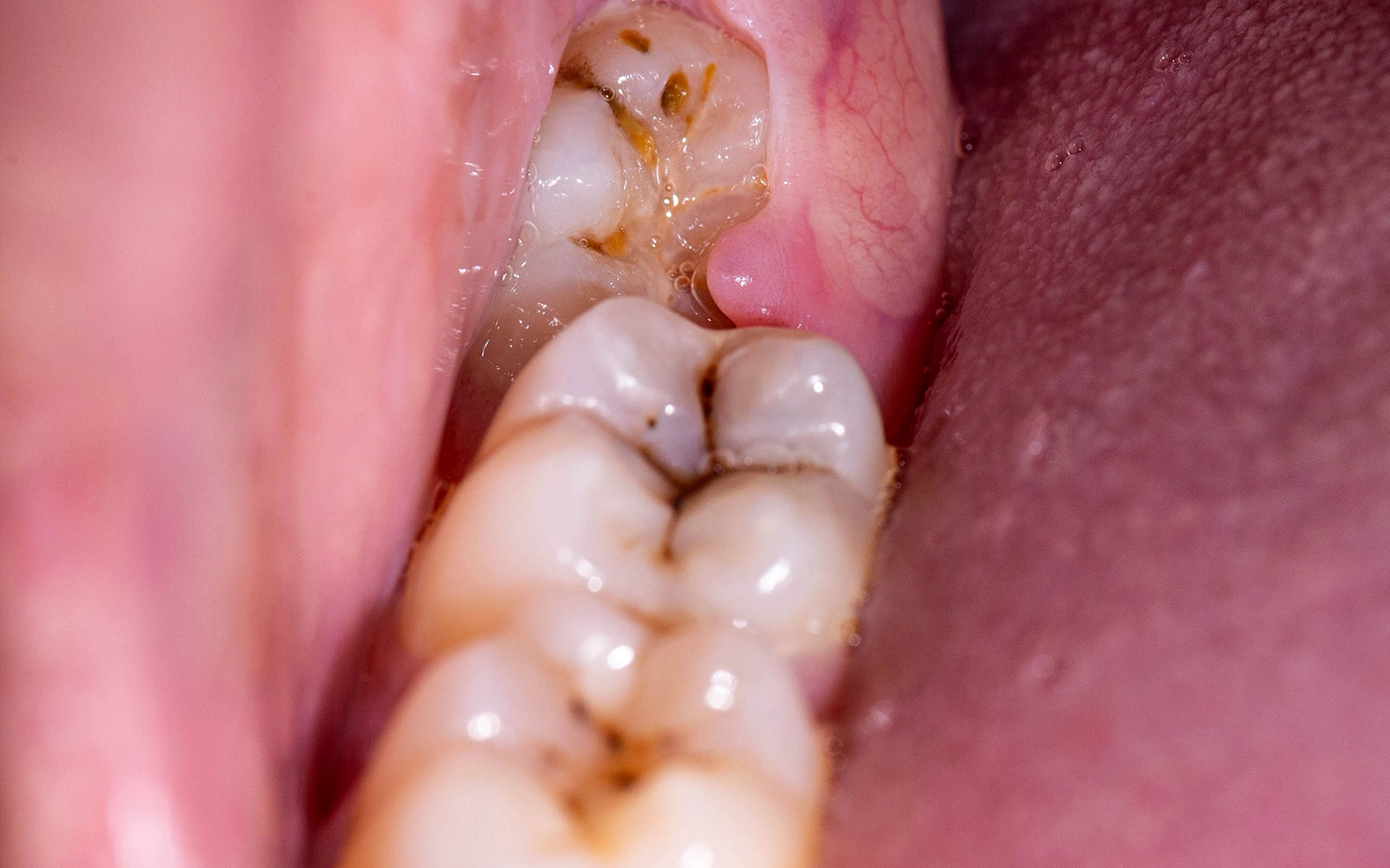 補綴物の材料選択の重要性