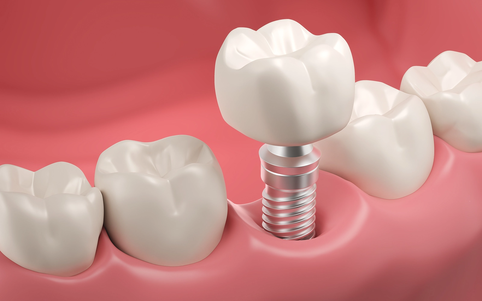「インプラント」を見る天然歯に近い噛み心地を実現