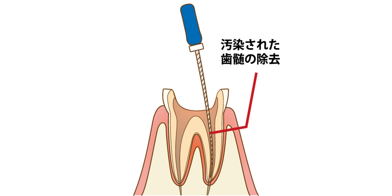 感染組織の除去