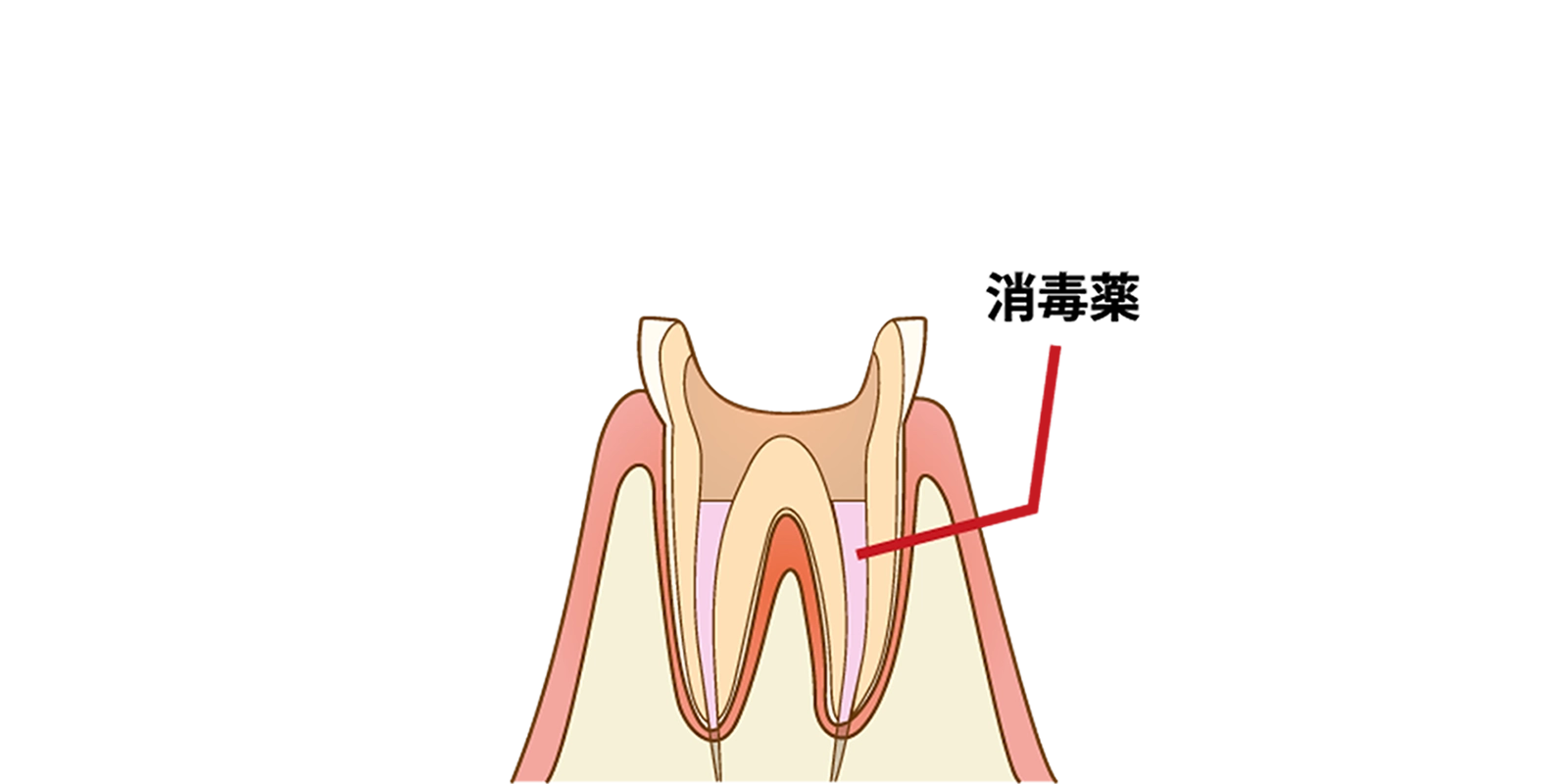 根管内部の清掃