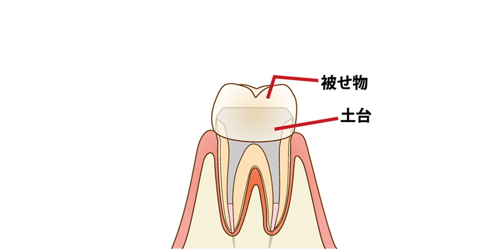 根管内部の封鎖