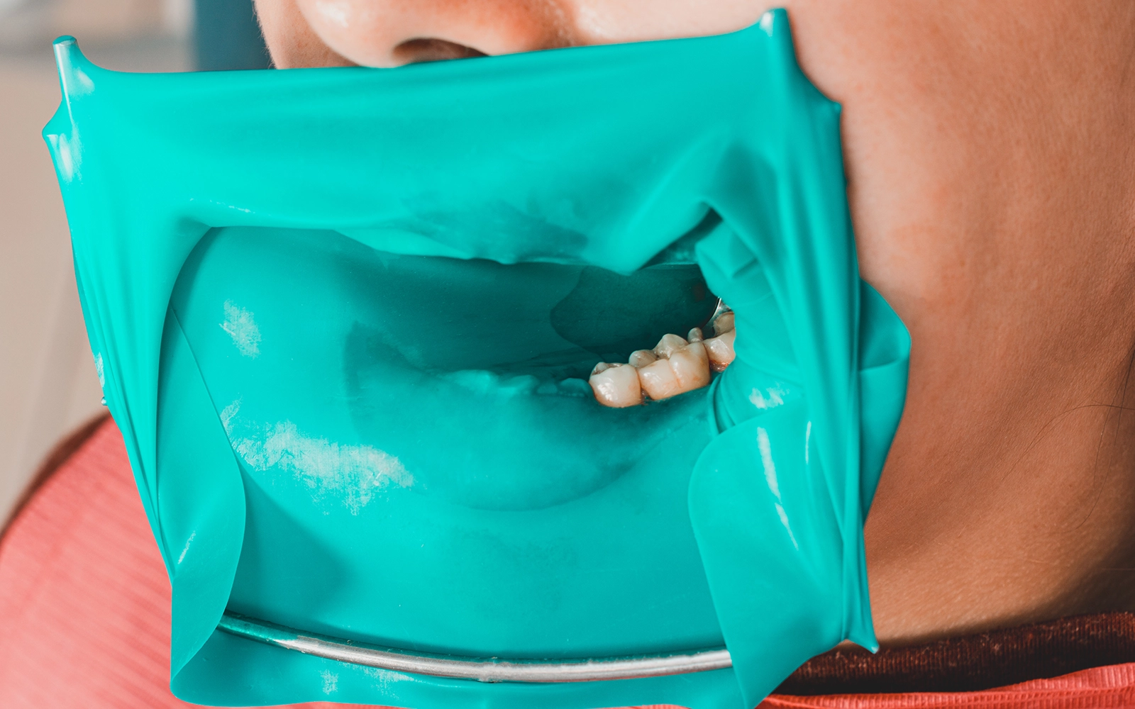 ラバーダムについて