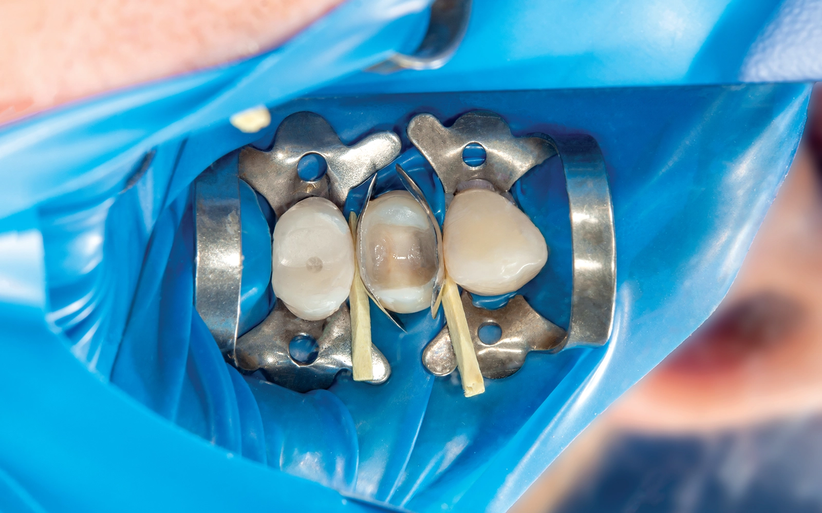 ラバーダム防湿とCT撮影の標準装備による治療精度の向上