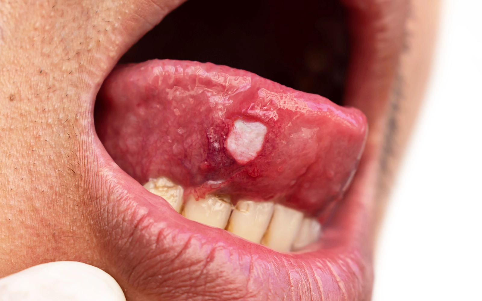 粘膜腫瘍・嚢胞の診断と治療