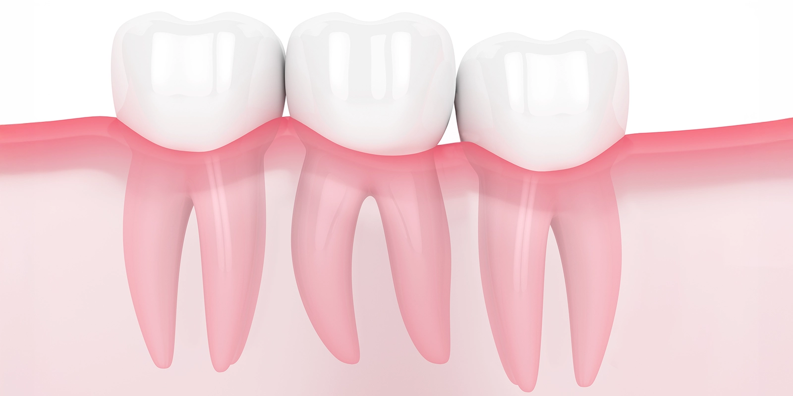 智歯周囲炎（ちししゅういえん）