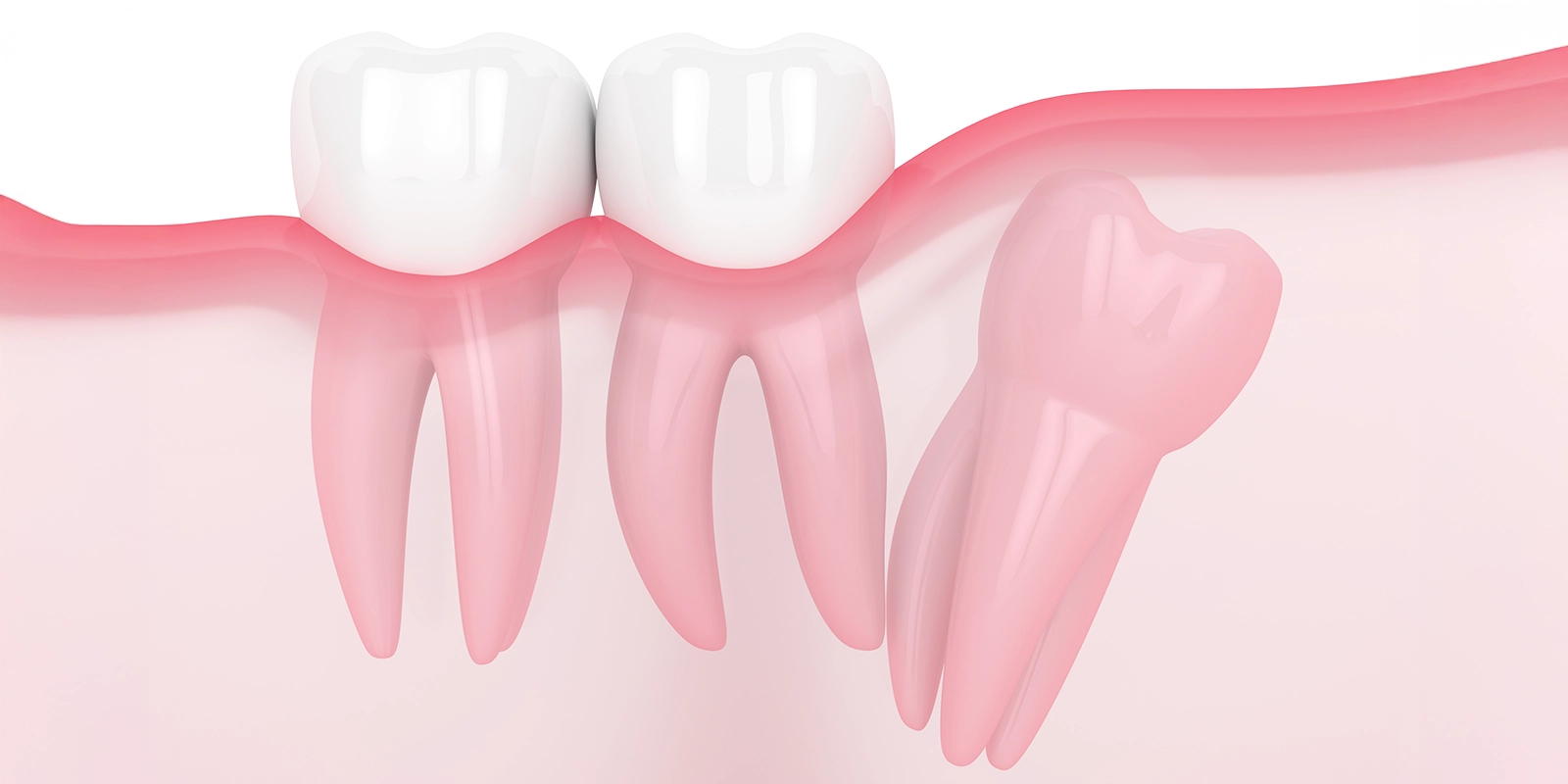 隣の歯への悪影響