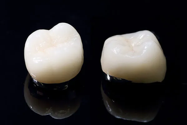 メタルボンドセラミックス（奥歯）