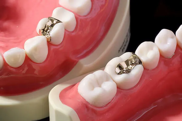 PGA合金インレー