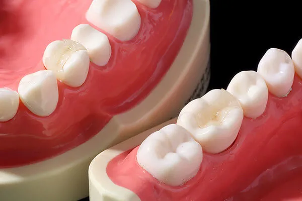 ジルコニアインレー