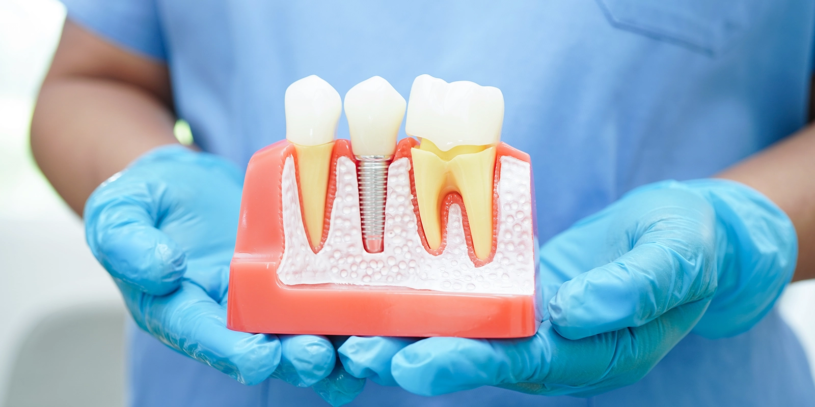 補綴（ほてつ）とは？