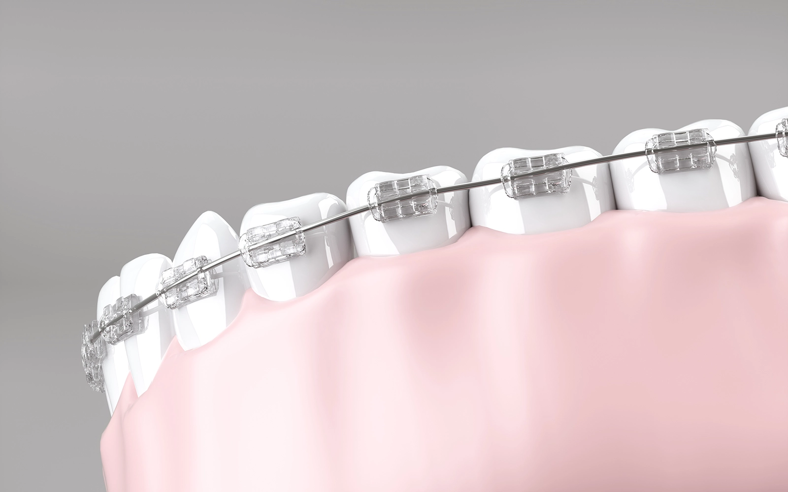 矯正治療後の補綴による完成度の向上