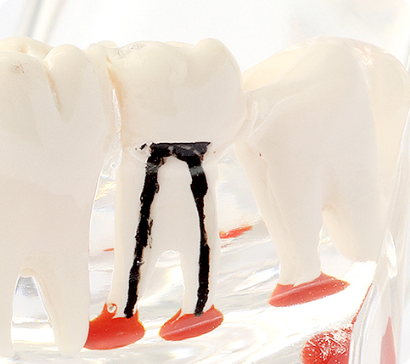 ひどい虫歯を放っておくと？