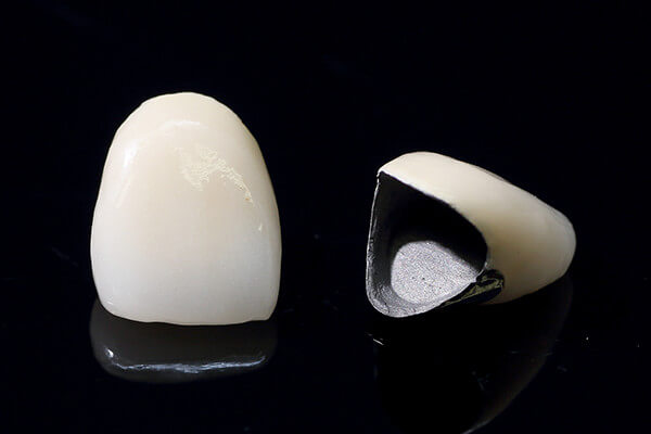 メタルボンドセラミックス