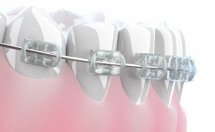 ワイヤー矯正（ブラケット矯正）