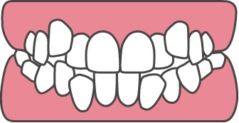 叢生（乱ぐい歯）