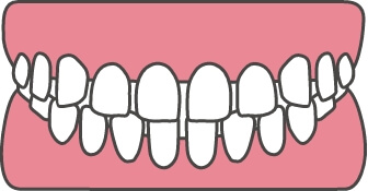 空隙歯列（すきっ歯）
