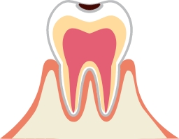 軽度の虫歯の場合