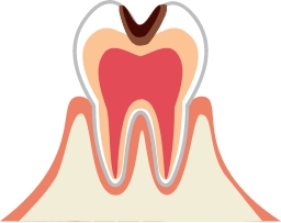 中程度の虫歯の場合