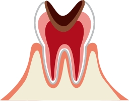 虫歯が神経まで到達している場合
