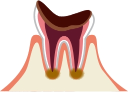 歯の根っこしか残ってない場合
