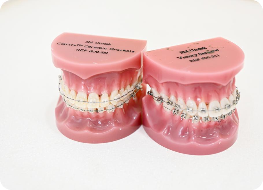 矯正治療の種類