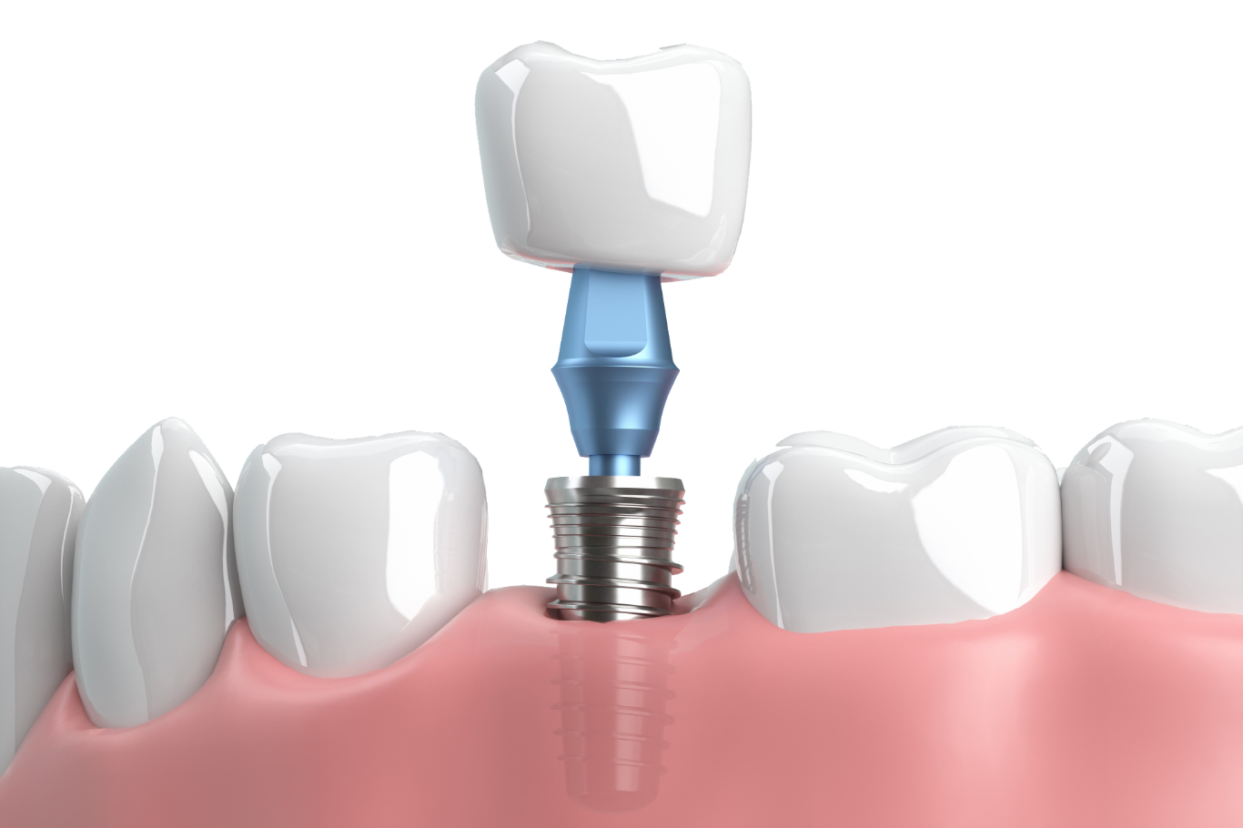 インプラント治療がそのお悩みを解決します