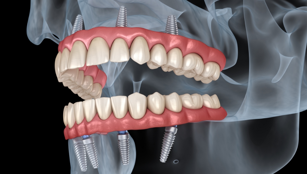 ワンデイインプラントとは？