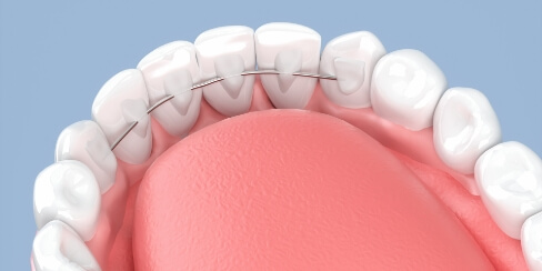 舌側矯正（裏側矯正）