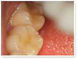 C1:歯の表面の虫歯