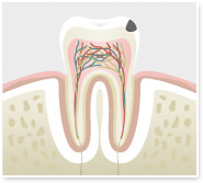 C2:歯の中の虫歯