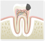 C3:神経まで進行した虫歯