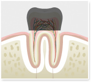 C4:歯の根まで進行した虫歯