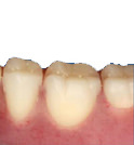 入れ歯のオプション セラミック人工歯