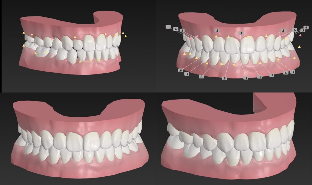 歯並びの事前シミュレーションが可能