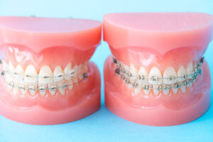 矯正歯科治療が大切な理由