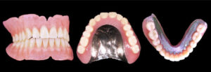 金属床義歯(丈夫で使いやすい入れ歯)